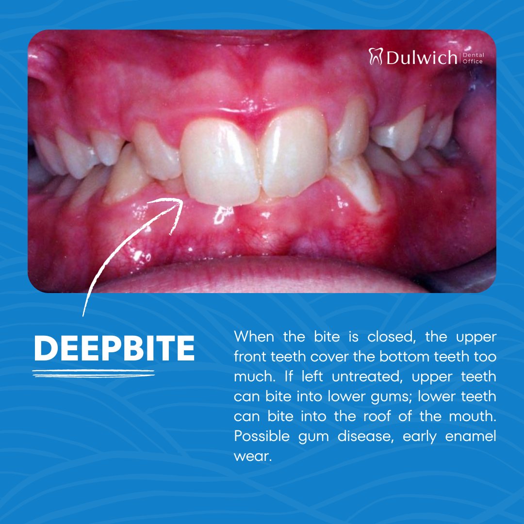 DulwichDentalOf's tweet image. Spot potential bite problems 💢 in your child and why early intervention is crucial 💙 (more photos in our Facebook post). Schedule an appointment with our specialist orthodontist today to ensure your child's healthy smile 🧒🏼✨. #DulwichDentalOffice #BiteProblems