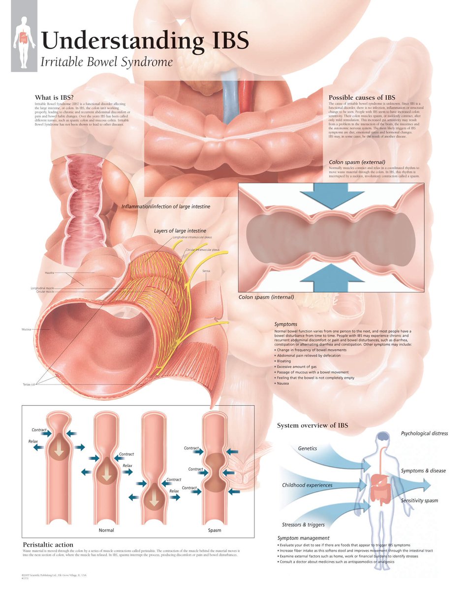 drkeithsiau's tweet photo. Since this infographic, we have learnt that IBS is a partially genetic condition with heritable components in 7% of patients, with SNPs that overlap with anxiety and depression. This dispels the myth that it is “all in the mind”.

(via @OBandarchi @RomeGastroPsych) https://t.co/uwybM1P7l0