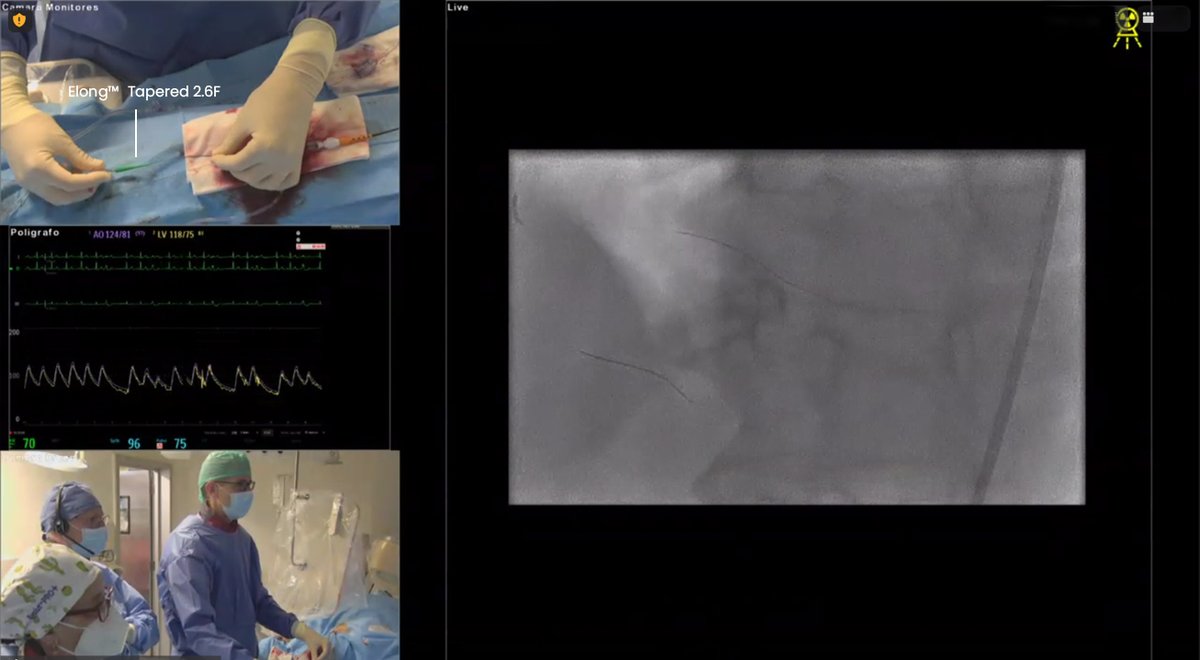 APTMedDevices's tweet photo. Many thanks to Dr. Alexandre Avran, and Dr. Ignacio Amat and congratulations for successfully performing 4 calcified CTO cases at Valladolid University Hospital, Spain, utilizing #Expressman™ GEC, #Elong™ tapered 2.6F Microcatheter and #CONQUEROR™ Lollipop NC balloon catheter. https://t.co/ESIvBJc8W3
