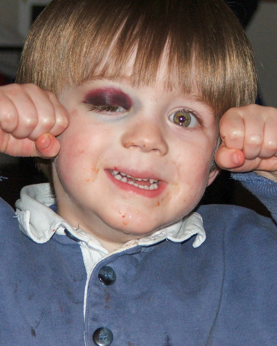 MY DEBUT SINGLE
‘A HEADACHE &amp; A BLACK EYE’ IS OUT NOW ON ALL PLATFORMS 💿😵 LISTEN HERE bfan.link/a-headache-and…