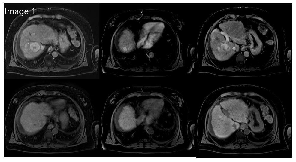 cirsesociety's tweet photo. #CIRSEtakeover Day 5 Case 2
Case by @PLucatelli w/ residents B. Rocco, S. Ciaglia, E. d’Amato, M. Giulia Travaglini, P. Vetri, C. Viola
64-yo male patient w/ NASH-related cirrhosis with multifocal HCC total burden beyond up to seven criteria. (1/5) https://t.co/R4hegknAak