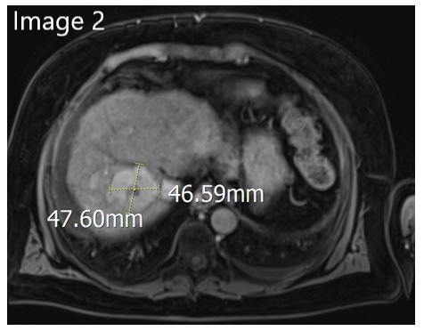 cirsesociety's tweet photo. Previous unsuccessful DSM-TACE that can promote liver function impairment: MELD 15, bilirubin 3,6 mg/dL, INR 1,4. (Image 1)
Treatment aims to downstaging the bigger target lesion (shown in image 2). (2/5) https://t.co/KJO2vrSPnT