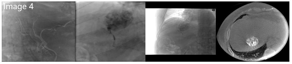 cirsesociety's tweet photo. B-TACE was performed selectively targeting the bigger lesion. Post-TACE non-enhanced CBCT demonstrates how b-TACE was able to permit dense deposition of the embolic within the target lesion, sparing the surrounding liver parenchyma. (4/5) https://t.co/Ls9L2LjhSz