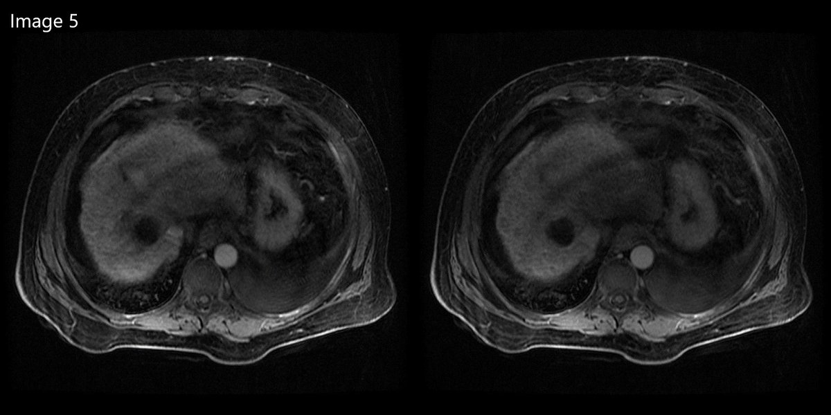 cirsesociety's tweet photo. b-TACE treatment achieved CR within a single session (Image 5).
OLT was achieved within 2 months from b-TACE treatment (Image 6).
#btace #downstaging #olt #transplant #pushingthebonduaries #cbct (5/5) https://t.co/QX8RDZ3rui