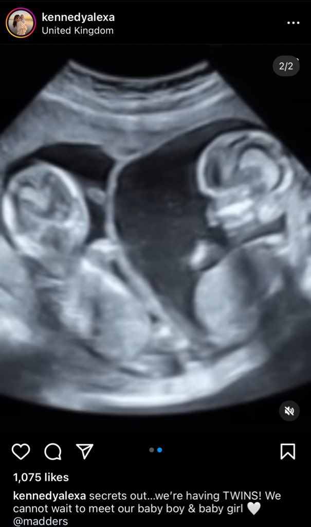 XtraLeicester's tweet image. 📲Congratulations to James Maddison and his girlfriend who are expecting twins!