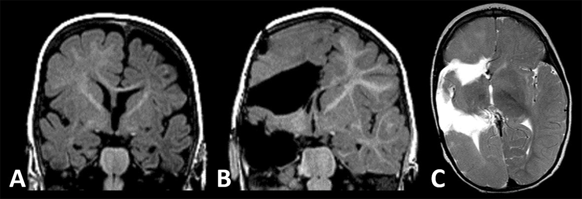 EpilepsiaJourn's tweet photo. #Hemispherotomy in Children: A Retrospective Analysis of 152 Surgeries in a Single Center and Predictors for Long-Term Seizure Outcome
https://t.co/K8AFjxlcyG
#Insularcortex #Disconnection #epilepsy #epilepsysurgery #ILAE @IlaeWeb @yesILAE @epilepsiajourn @WileyNeuro https://t.co/kK8Xz1NIg0