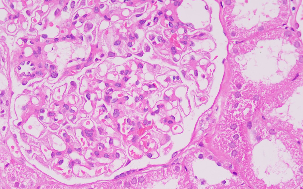 draalok's tweet photo. Classical case..young male with sickle cell disease. Creatinine 1.8mg%, 24 hours urine protein 2.4 gm, S.albumin 3.4g%. Marked glomerulomegaly. Sickle cells in LM and EM. Endothelial injury and secondary podocytopathy. #sicklecelldisease #pathology #Nephpearls #renalpathology https://t.co/SdChydY9cx