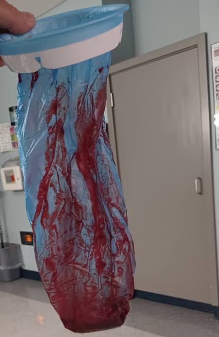 Vaping vs lung damage 

Vaping products (electronic cigarettes or e-cigarettes) are devices that heat a liquid into an aerosol that is inhaled (breathed in) into the lungs. These devices are commonly called vapes, mods, e-hookahs, sub-ohms, tank systems and vape pens.