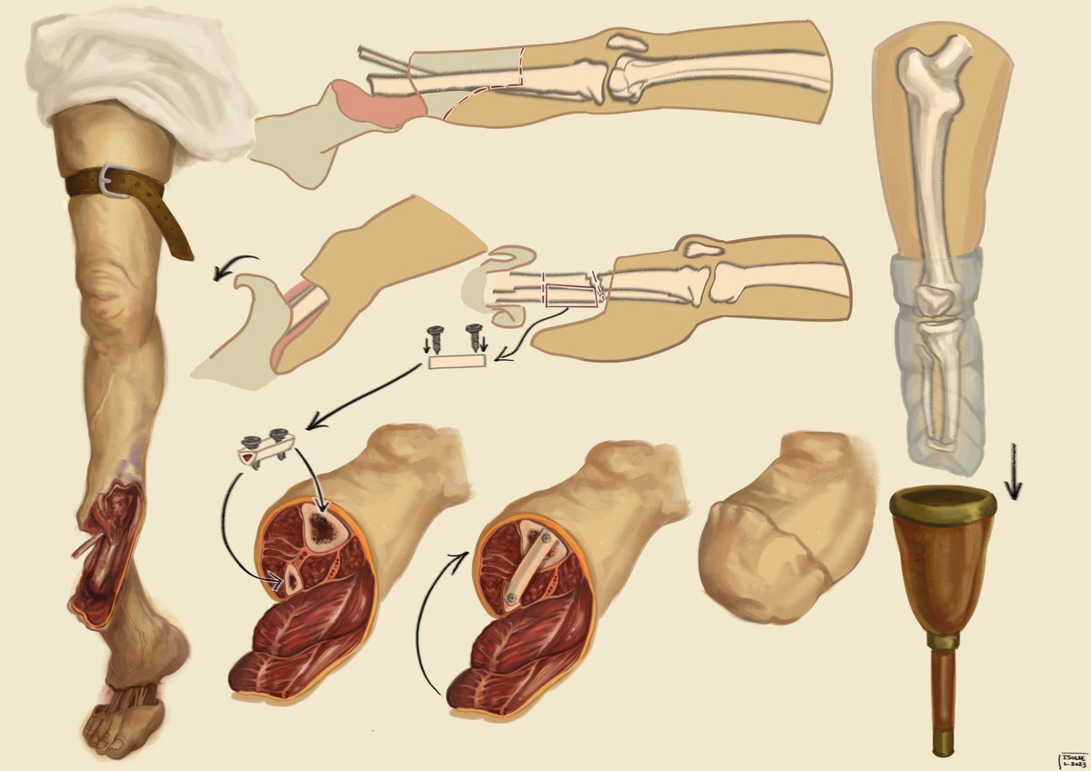 miieandering's tweet photo. Recovery of 67-year-old man from beast mauling with below-the-knee amputation and reconstruction (Ertl's) #bloodborne https://t.co/d1WRgcgKFa