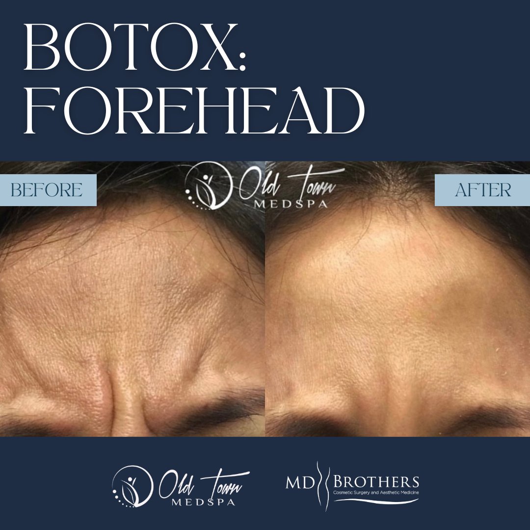 Here's an incredible transformation of one of our patients who softened her forehead lines with neurotoxins-

Click the link in our bio to schedule a free consultation with same day treatment.

#foreheadbotox #neurotoxins #foreheadwrinkles #aesthetics #chicagomedspa