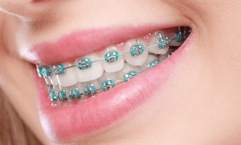 AllSmilesAllen's tweet image. $500 off of orthodontic treatment, for a limited time! Straight teeth are healthier! When your teeth are aligned, they are less likely to get tooth cavities and gums disease over time. Book your Free Consult today! bit.ly/3FqH8Vs