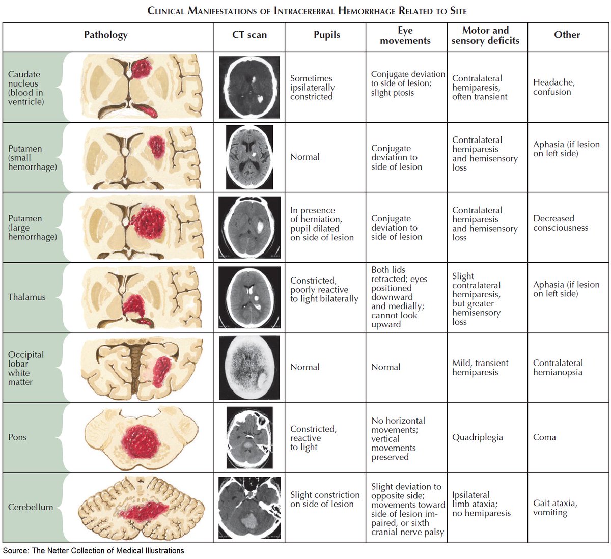 Clinical Manifestations of Intracerebral Hemorrhage Related to Site

#medtwitter #foamed #meded #Neurology