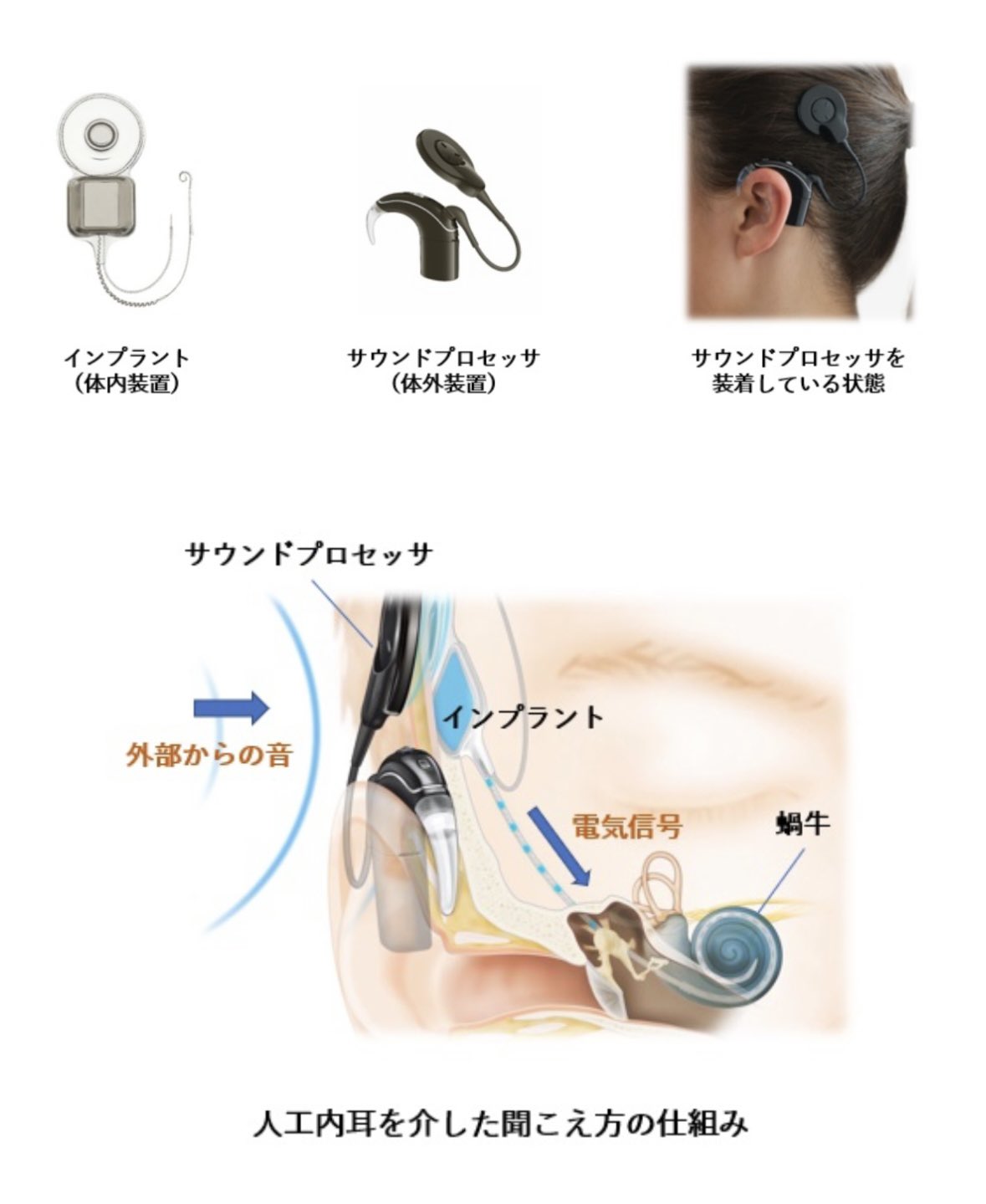 【数量限定】旧モデル在庫処分セールを開催します！ 人工内耳 音入れ ,N7 プロセッサーカバーN6 健康・医学