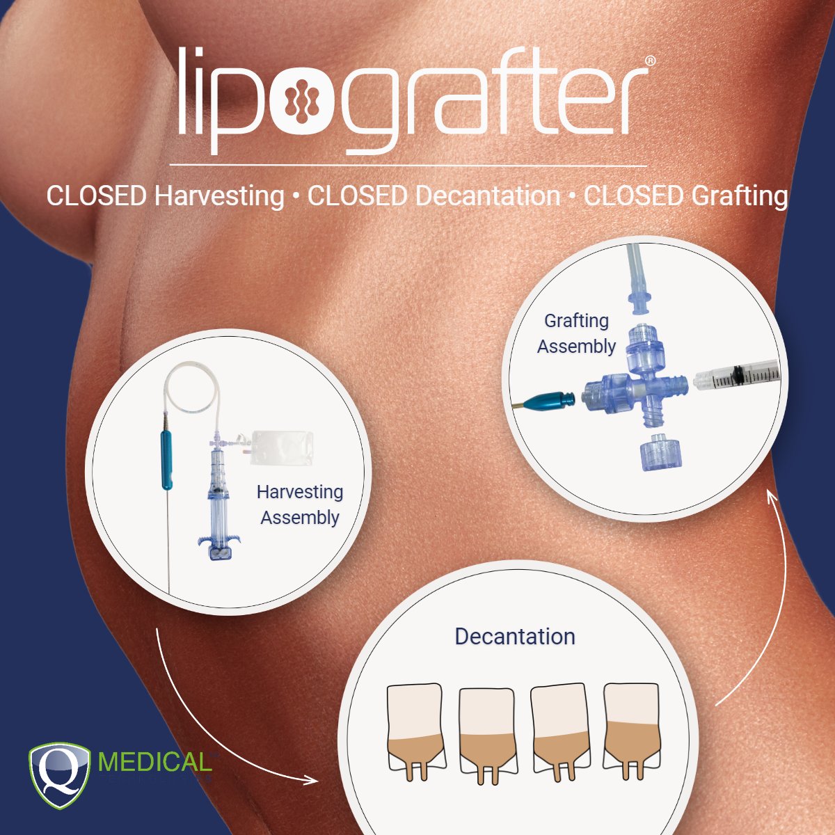 Lipografter... The all-in-one closed fat grafting system that optimizes cell viability.

#QMedical #lipografter #closedharvesting #closeddecantation #closedgrafting #polytech
