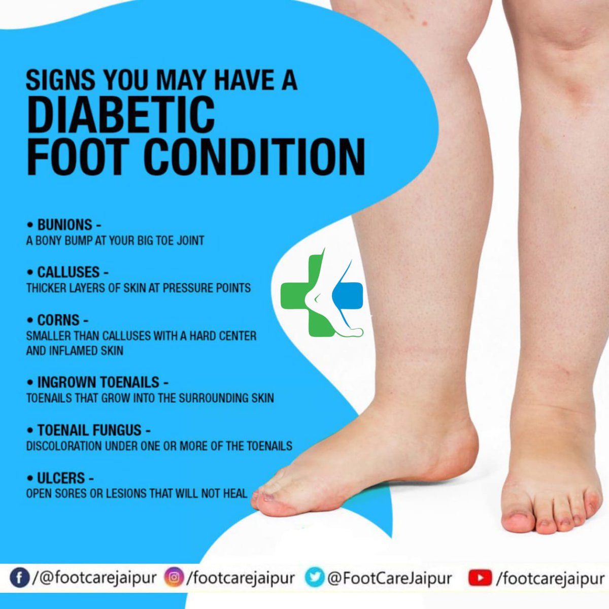 Diabetic foot has become one of the Major reasons for Amputation. 

Anyone who is diabetic is advised to see a Podiatrist/ Foot Doctor/ Orthotist on regular intervals for needful intervention to reduce risk.

#FootCareJaipur 
#FootProblems 
#diabetes 
#DiabeticFoot
#FlatFoot