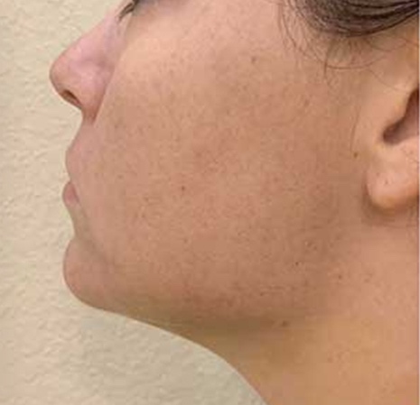 Before &amp; After ➡ swipe to see! 
Jawline contouring is a non-surgical option to help reduce the effects of age-related volume loss in the lower face by adding volume to the jaw and sculpting the contour of the lower face to achieve a more defined jawline. 

#medispa #botox #be...