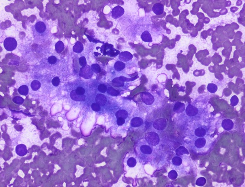 pepeheffernan's tweet photo. CC274. This patient may very well not have it, but he does. This particular patient has one of the following autoantibodies (poll below) #cytopath
@DrBMcGinn @premcharles @DonTohE @goziemnweke @TristanRutland7 @smlungpathguy @DKalodimou @atman_ci @twmarkc @PoloniaAntonio https://t.co/P4G9tXaKnZ