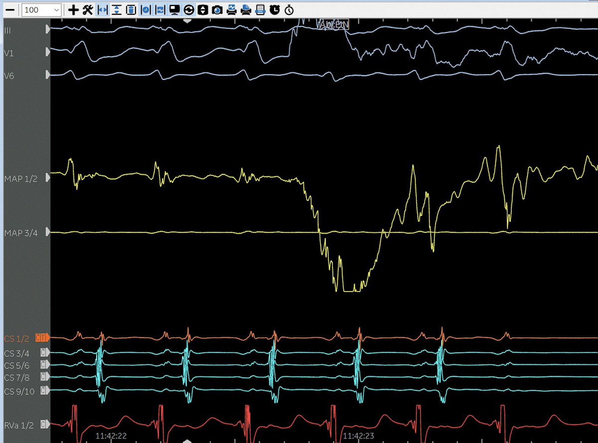 Termination of AVRT in a Patient with left sided concealed AP after less than 1 second of RF application. Satisfying case to leave for the weekend. <a href="/Leonard_Bergau/">Leonard Bergau</a> <a href="/NibrasSoubh/">Nibras Soubh</a> <a href="/ChristianHeeger/">Christian-H. Heeger</a> <a href="/Phiso_de/">Philipp Sommer</a> <a href="/SamuelSossalla/">Samuel Sossalla</a> <a href="/YoungDgk/">Young DGK</a> <a href="/yourUMG/">Universitätsmedizin Göttingen (UMG)</a> <a href="/AGEP_DGK/">AGEP</a>