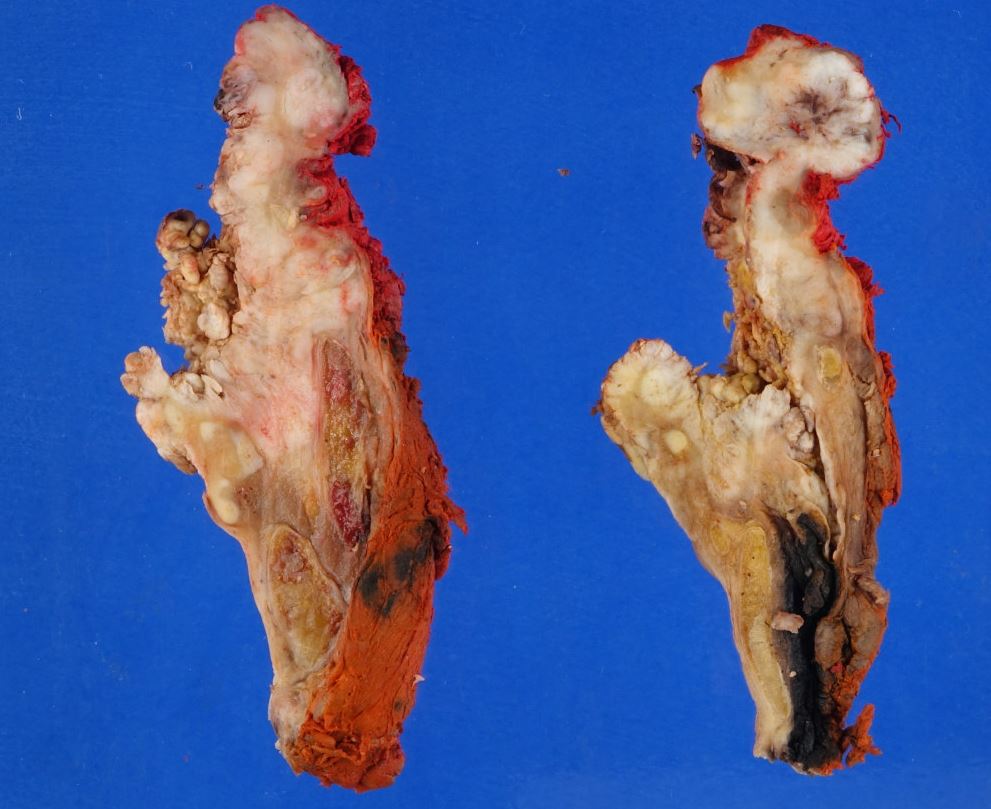 Laryngectomy, easily least favorite specimen to gross…fun to ink though!

Here the tumor (SCC) is oropharyngeal, arising from the vallecula and extending into supraglottis (different -and much easier!- TNM staging protocol than its laryngeal-origin counterpart).

#grosspath