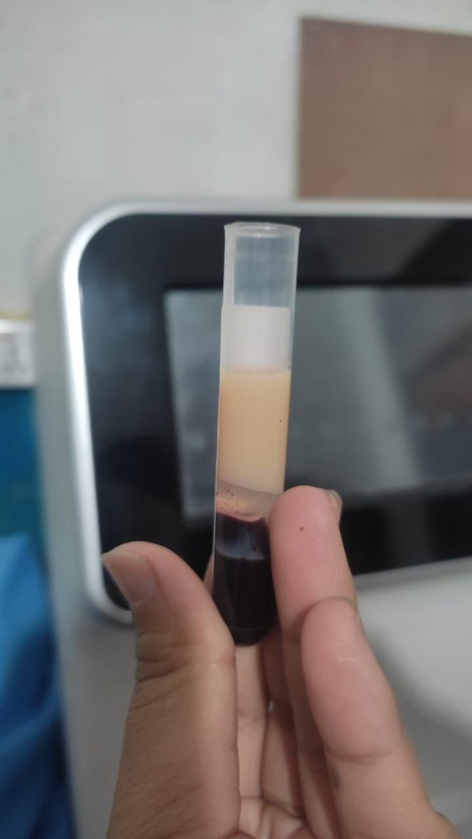 sanjibks1969's tweet photo. The reason we are working in/with  community “ 32 years lady. No symptoms. Fasting glucose: 316 mg /dl. HBA1c: 12.9%. Cholesterol (mg/dl)- Total 408, HDL:58, Triglyceride:1540, LDL: 242” https://t.co/LUsTLNH9CA