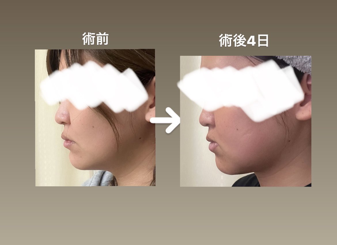固定とれたー🥺
腫れてるからなんとも言えないんだけどさ
普通に顎なげぇむり🥺笑
オトガイは5mm下げてもらったらしいんだけど
腫れてるから顎長く見えるのかな？😭
正面の変化は今のところ腫れすぎててわからない🥺