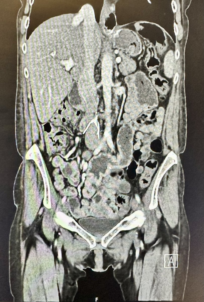 jcgeorgemd's tweet photo. #PennsyInterventions CaseFiles: 
How would you approach this complex retrieval of angulated 10 yr old IVC filter with externalized embedded apex/hook and penetrating struts? @GPAngioClub @PennCVFellows @PennCardiology @ACVCPhila @ReVascMed https://t.co/732dL4kZbR