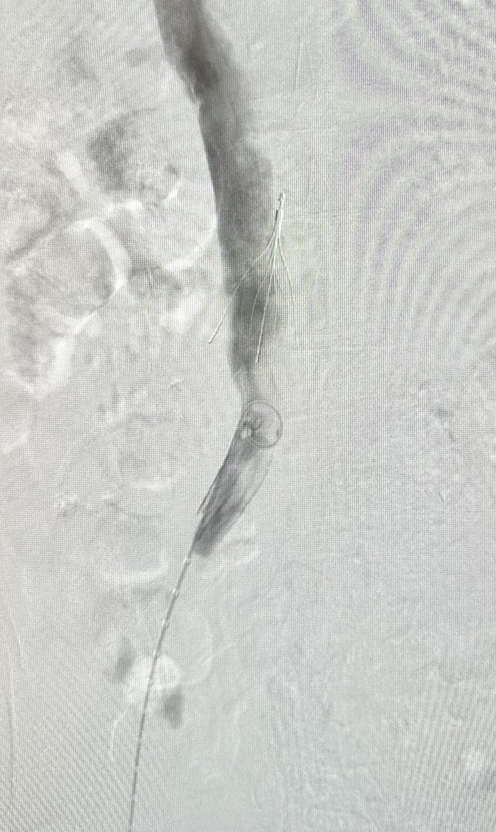 Jon George (@jcgeorgemd) on Twitter photo #PennsyInterventions CaseFiles:
How would you approach this complex retrieval of angulated 10 yr old IVC filter with externalized embedded apex/hook and penetrating struts? <a href="/GPAngioClub/">Phila Angio Club</a> <a href="/PennCVFellows/">Penn Cardiology Fellows</a> <a href="/PennCardiology/">Penn Cardiology</a> <a href="/ACVCPhila/">Academy for CardioVascular Collaboration</a> <a href="/ReVascMed/">ReVascMed</a> #PennsyInterventions CaseFiles:
How would you approach this complex retrieval of angulated 10 yr old IVC filter with externalized embedded apex/hook and penetrating struts? <a href="/GPAngioClub/">Phila Angio Club</a> <a href="/PennCVFellows/">Penn Cardiology Fellows</a> <a href="/PennCardiology/">Penn Cardiology</a> <a href="/ACVCPhila/">Academy for CardioVascular Collaboration</a> <a href="/ReVascMed/">ReVascMed</a>