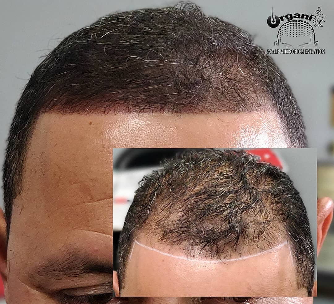 Organic_SMP's tweet image. Adding Density With Scalp Micropigmentation
#scalp #hairloss #micropigmentation #hairthining #hairlosssolutions #medicaltattooist