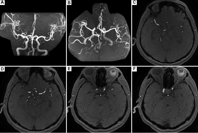 AN_ASP_'s tweet image. Welcome to read this article from Advanced #Neurology.🤓 
#Choreoathetosis of the upper limb with #contralateral substantia nigra #lacunar infarction: A case report and literature review

Please read more details:👇👇
accscience.com/journal/AN/2/1…