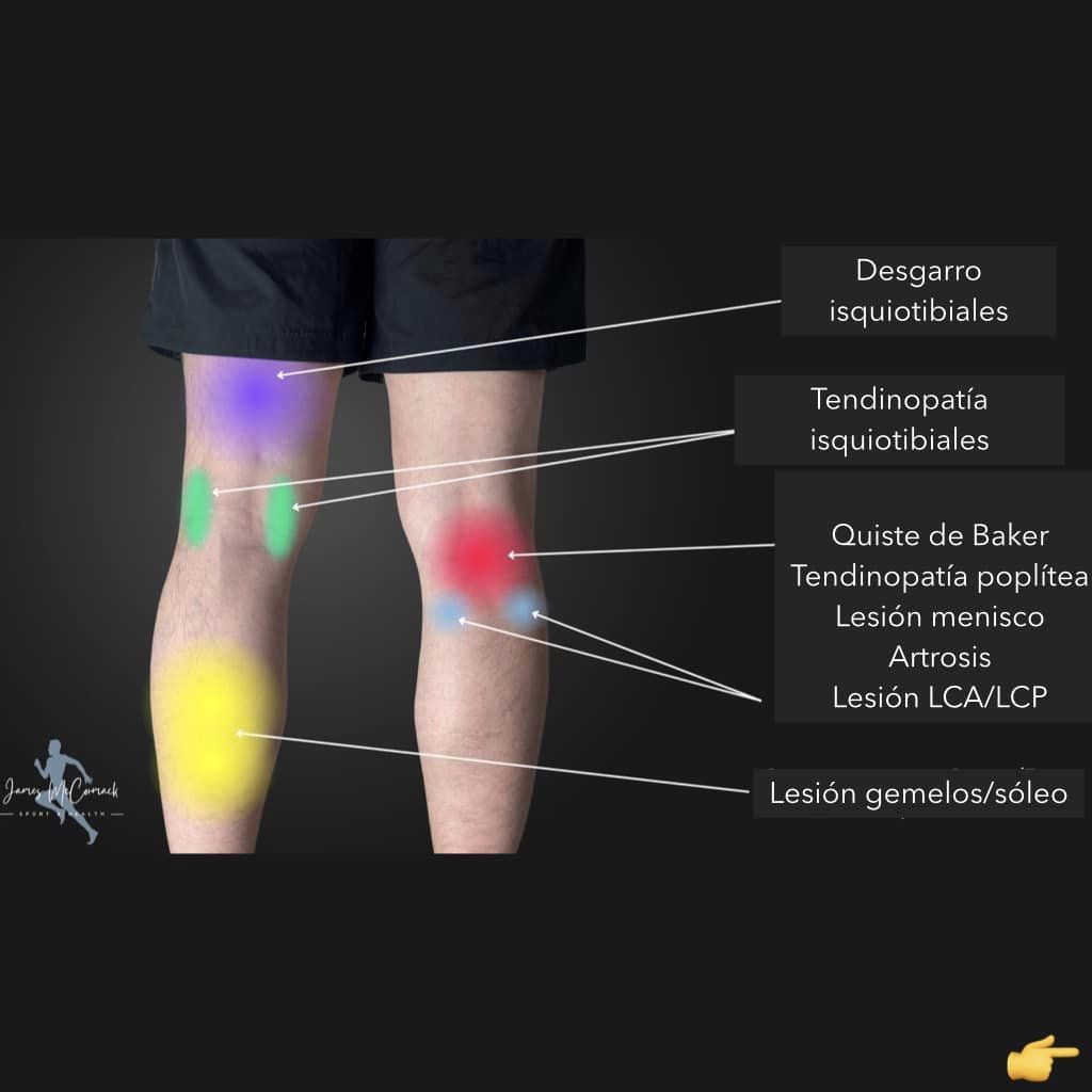 AgenciaEbp's tweet photo. 👇 ¡Descubre en imágenes todas las patologías de la rodilla según las diferentes zonas anatómicas!
Crédito: James Mc Comarck
#anatomia #rodilla #lesiones #patología #LCA #menisco #isquiotibiales #cuadriceps #rotula #tendinopatia
https://t.co/Be5KPKpFnV https://t.co/QZtMECb32T