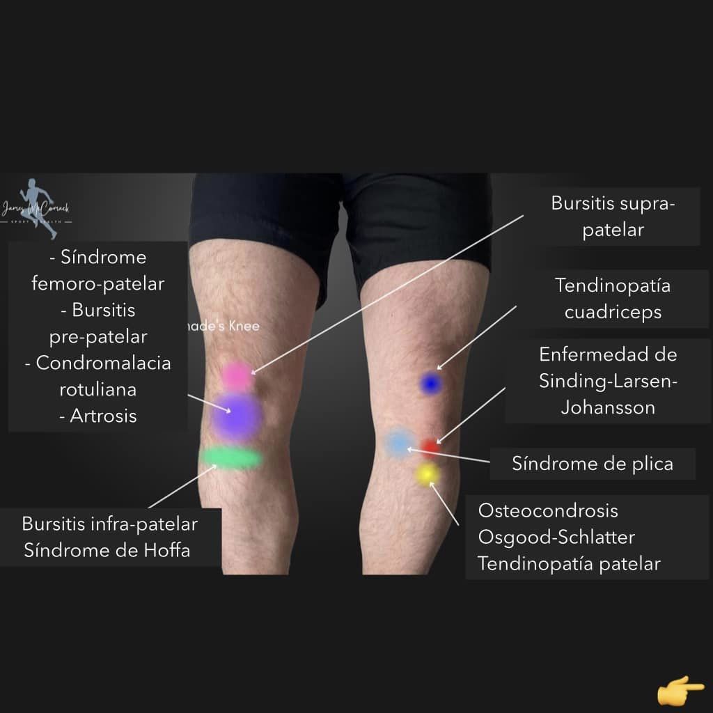 AgenciaEbp's tweet photo. 👇 ¡Descubre en imágenes todas las patologías de la rodilla según las diferentes zonas anatómicas!
Crédito: James Mc Comarck
#anatomia #rodilla #lesiones #patología #LCA #menisco #isquiotibiales #cuadriceps #rotula #tendinopatia
https://t.co/Be5KPKpFnV https://t.co/QZtMECb32T