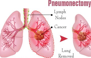 ejmaces123's tweet photo. A simple #pneumonectomy removes just the #lung. An extra pleural pneumonectomy take away part of the #diaphragm, the parietal pleura, and the pericardium on that side as well https://t.co/BoRUtnNsJM