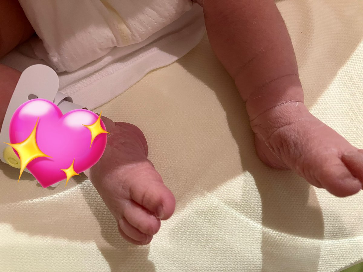 tomochuuunz's tweet image. 【出産のご報告】
予定日ﾋﾟｯﾀﾘの本日7:40
VBACで女の子を出産しました👶🎀

上の子より約2週間長くお腹にいたからか、産まれてすぐから
ほっぺぷくぷくbabyでした🥰

#VBAC #帝王切開後の経膣分娩トライ #TOLAC
#計画誘発分娩 #鉗子分娩