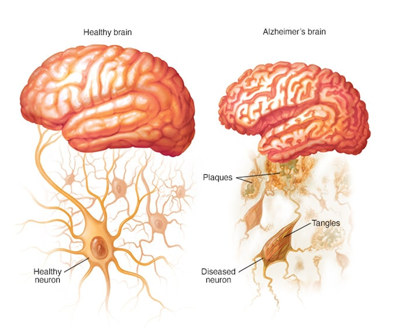 HealthOverhaul's tweet photo. Make Alzheimer's optional.

Truth is, Alzheimer's should be a RARE disease.

15% will die because of it and this could double by 2060. But this does not have to be.

Alzheimer's is the ultimate poster girl for prevention.

Any one of these 7 outperforms ANY Alzheimer's drug we currently have.

1. Nutrition
2. Exercise
3. Get great sleep
4. Stress reduction
5. Brain training
6. Targeted supplements
7. Detox

Prevention is HIGHLY effective, but not profitable, hence why you're not hearing much of it.

Profits come from treating you when you're sick NOT preventing you from ever becoming ill in the first place.

In depth Thread coming soon.