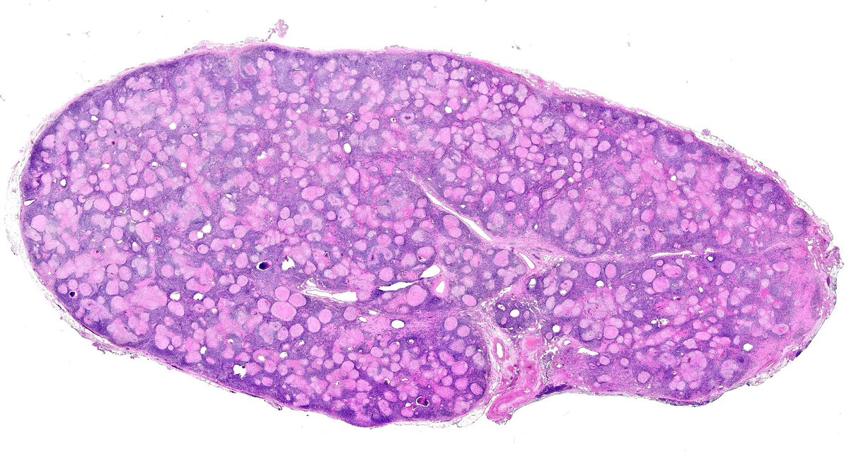 #SurgPath Just sharing this stunning lymph node 🤩🤩🤩🤩 with sarcoidal type granulomas in a patient with known SARCOIDOSIS. ZN and Di-PAS negative and also neg for Mycobacterium PCR