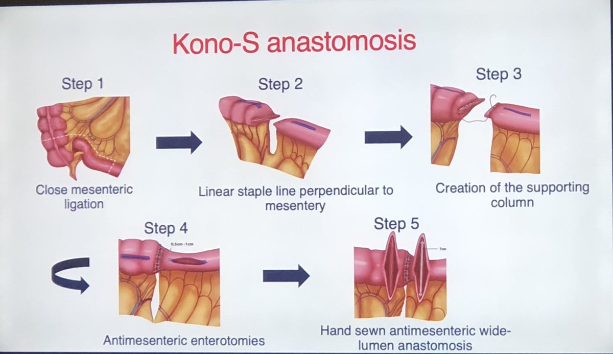 Muhammad Rafaih Iqbal (@mriqbalsurg) on Twitter photo Phenomenal talk by <a href="/MissLHancock/">Laura Hancock</a> on anastomosis in Crohn’s
🔑 for anastomosis in CD👇
➡️ Safety ( low leak rate )
➡️ Low recurrence
📍Kono-S has both ! Phenomenal talk by <a href="/MissLHancock/">Laura Hancock</a> on anastomosis in Crohn’s
🔑 for anastomosis in CD👇
➡️ Safety ( low leak rate )
➡️ Low recurrence
📍Kono-S has both !