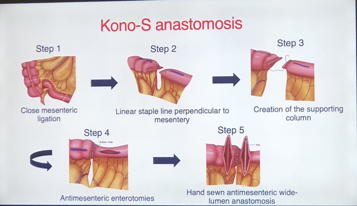 Phenomenal talk by @MissLHancock on anastomosis in Crohn’s 🔑 for anastomosis in CD👇 ➡️ Safety ( low leak rate ) ➡️ Low recurrence 📍Kono-S has both !