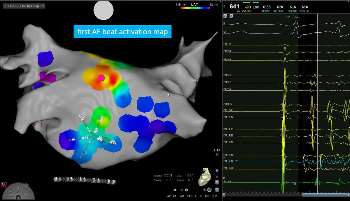 Focal px AF due to extrapulmonary TRIGGER in a patient with a successful previous PVI with Farapulse PFA. Mapping beginning of each AF episode led us there, posterior LA. AF episodes reproducibly elicited by high-dose isoproterenol (blue EGMs pentaR in LA, red: RA, pink: CS)…