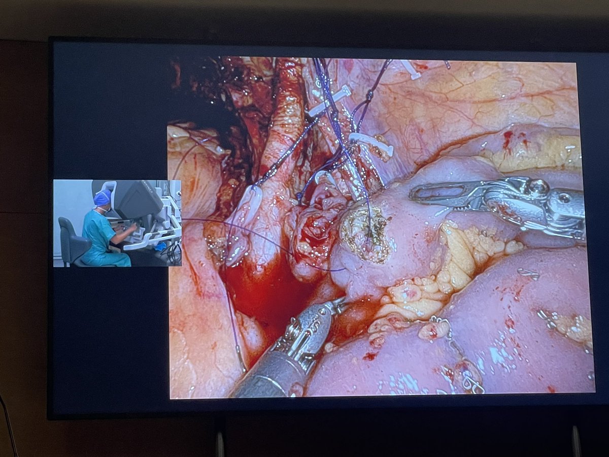 #livesurgery urinary diversion @PheVeronique @SurgeryIsFemale