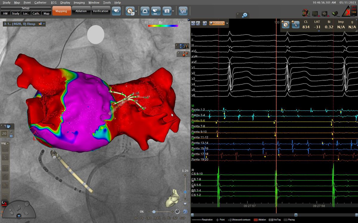 ๐ป๐๐๐๐ ๐ถ ๐ผ๐๐๐๐๐๐ (@laila_g) on Twitter photo Very nice case. AF redo ablation. Just before begining ablation. #EPeeps #cardiotwitter @JosMart42952309 <a href="/CarlosMinguito/">Carlos Minguito</a> Very nice case. AF redo ablation. Just before begining ablation. #EPeeps #cardiotwitter @JosMart42952309 <a href="/CarlosMinguito/">Carlos Minguito</a>