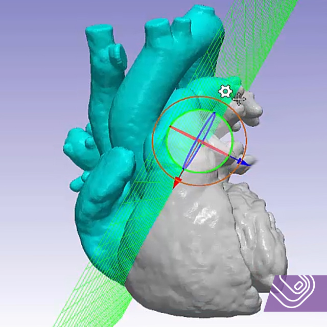 Simpleware_SNPS's tweet image. Our FDA 510(k)-cleared @Simpleware_SNPS workflows for generating files for 3D anatomical printing generates accurate heart models for increasing confidence in clinical decision-making bit.ly/2ThbCDZ #medical3dprinting #cardiovascular #3dheart #pointofcare #medicalimaging