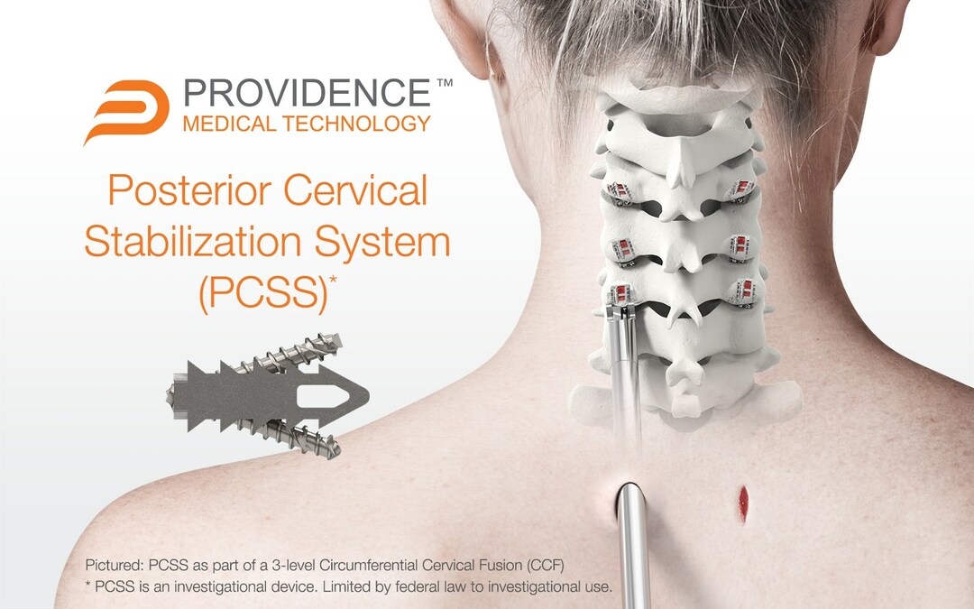 We've completed enrollment in our FUSE Study — a prospective, multicenter, randomized, IDE clinical study evaluating the safety &amp; effectiveness of Posterior Cervical Stabilization System (PCSS) in 3-level cervical fusion patients. prn.to/3LU8XYO
