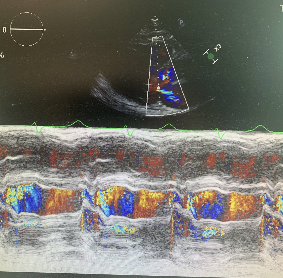 GaryParizher's tweet photo. Diagnosis in one image! #CardioTwitter #echofirst https://t.co/H4ryAvRmur