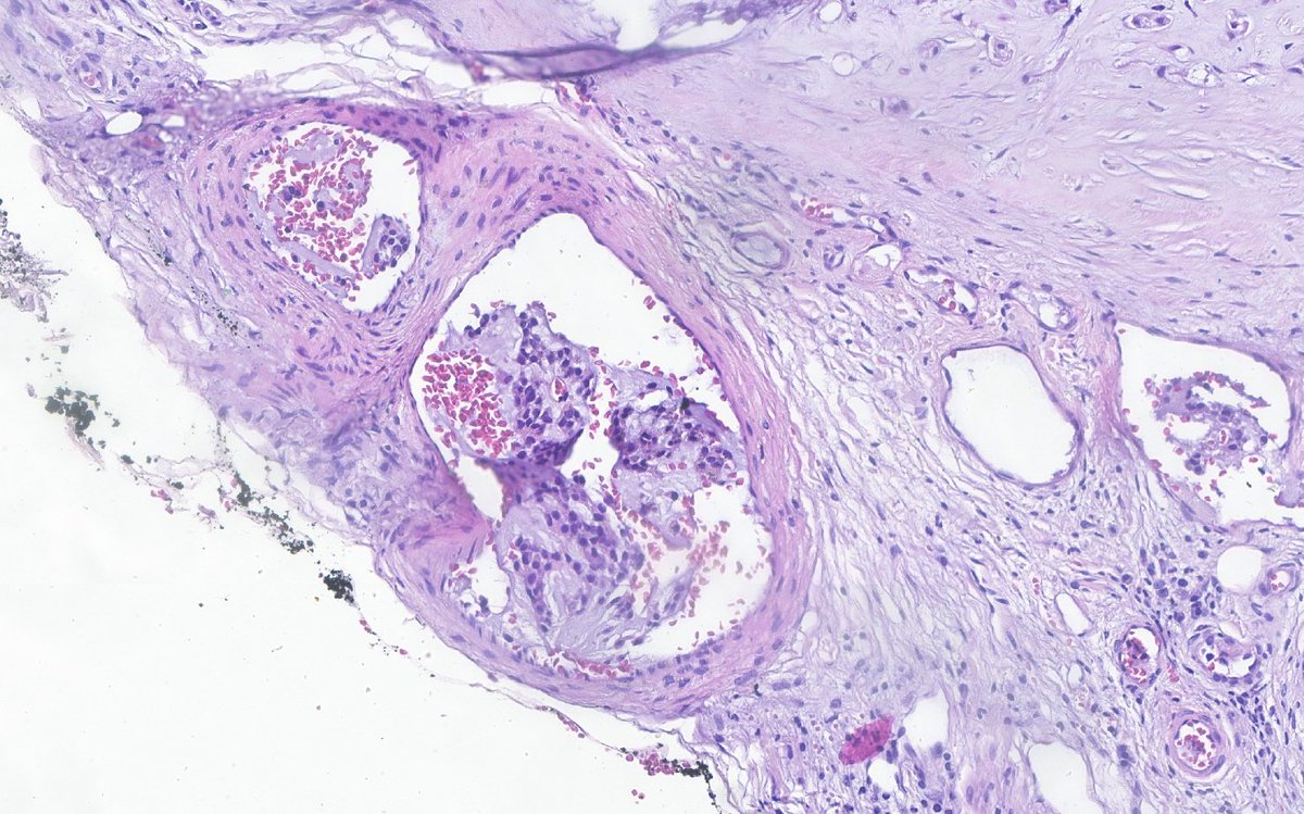 Intravascular tumor invasion in pleomorphic adenoma. Unknown biological significance, but it could be assiciated with FNA.