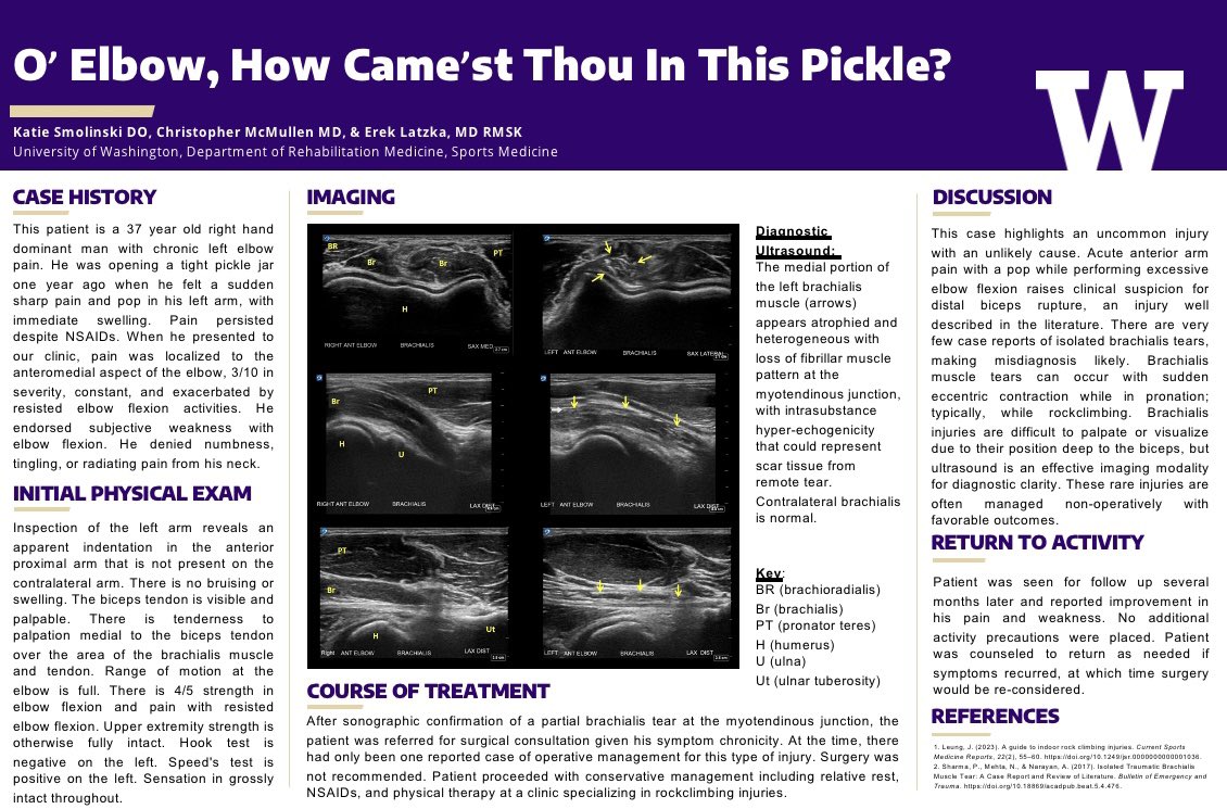 ErekLatzkaMD's tweet image. Catching up on #AMSSM2023. New record of 7 case reports with UW residents and fellows this year. Best title by far: “O’ Elbow, How Came’st Thou in This Pickle” by our chief @KSmo_DO 

@UWRehabMed @TheAMSSM #shakespeare #sportsmedicine #mskultrasound #mskrad