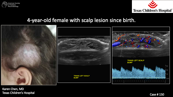The_ASPNR's tweet photo. Case of the Week: 4-year-old female with scalp lesion since birth 

Thank you Karen Chen, MD for sharing this case!  #PediNeuroRad #MedEd #FOAMrad #PedsRad #RadRes #NeuroRad #FOAMmed https://t.co/uEOGC2QaMv