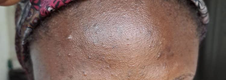 This is a congested skin. Congestion means it has clogged pores, these tiny tiny stuff (Nigerians call is rashes). 

They’re clogged pores which may result in Blackheads, whiteheads or inflammatory acne. 

Treatment