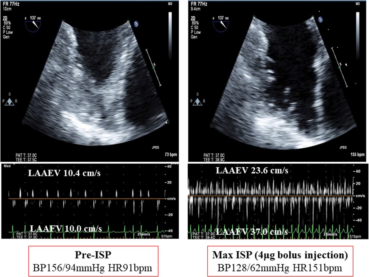 ASE360's tweet photo. In this @JournalASEcho article, our authors aimed to assess the effectiveness of the stepwise increase of isoproterenol (ISP) bolus dose method for distinguishing left atrial appendage (LAA) sludge from thrombus.

Read the article: https://t.co/cuyr39VgFu #echofirst https://t.co/Yv0acIhUR8