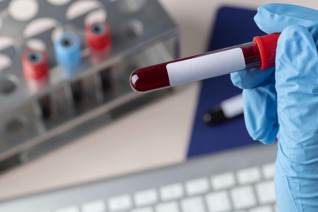 Prueba de sangre impulsada por IA permite detección temprana del cáncer de páncreas en pacientes de alto... labmedica.es/diagnostico-mo…