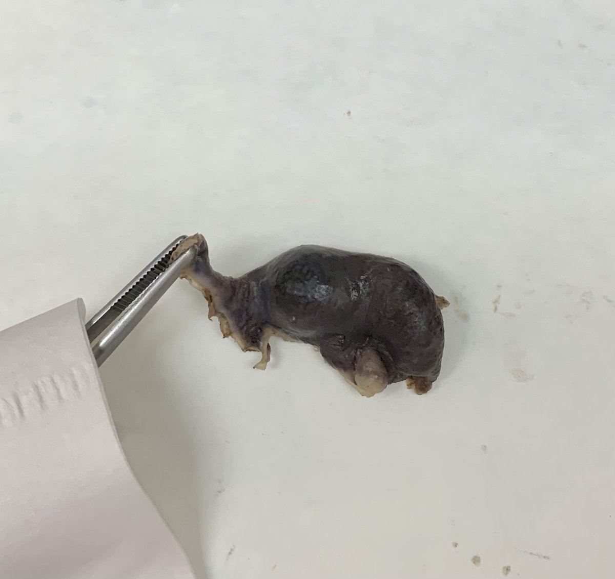 AMColinoG's tweet image. Gross and microscopic images #GynPath #TwitterPath